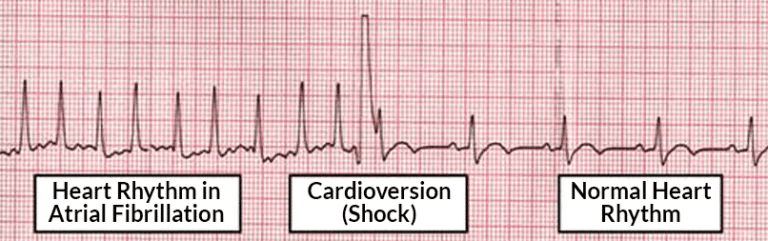 Becoming Familiar with Synchronized Cardioversion - ACLS.com